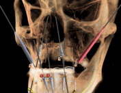 zygoma implant planning, all on 4 , all on 6 implants
