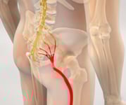 Sciatica