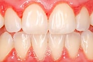 inflammation gencives gingivite