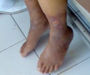 Discolouration and ulceration of the legs