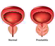 Benign Prostatic Hyperplasia