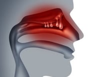 Nasal Polyps