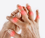 Rheumatoid Arthritis