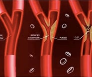 1. ATHEROSCLEROSIS