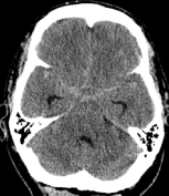 Tomografia computadorizada de um homem de 45 anos com hematoma intracerebral.