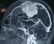 This tumour infiltrated the major dural venous sinus