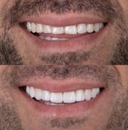 Facetas antes e depois dente pequeno