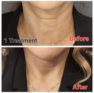 RF Microneedling before and after only one treatment