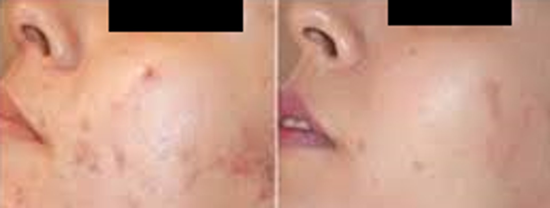 before and after acne mezo