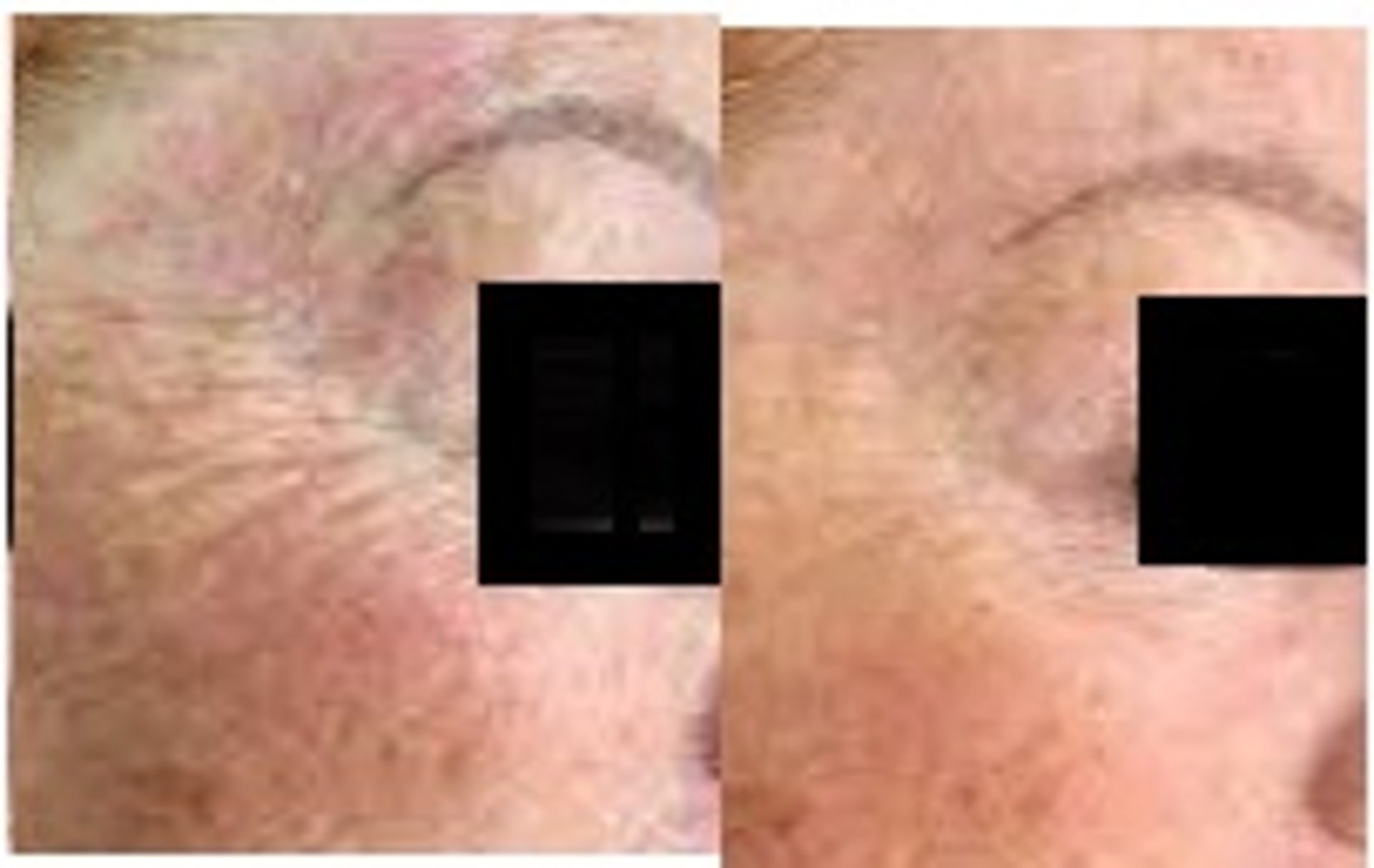 before and after eye mezo