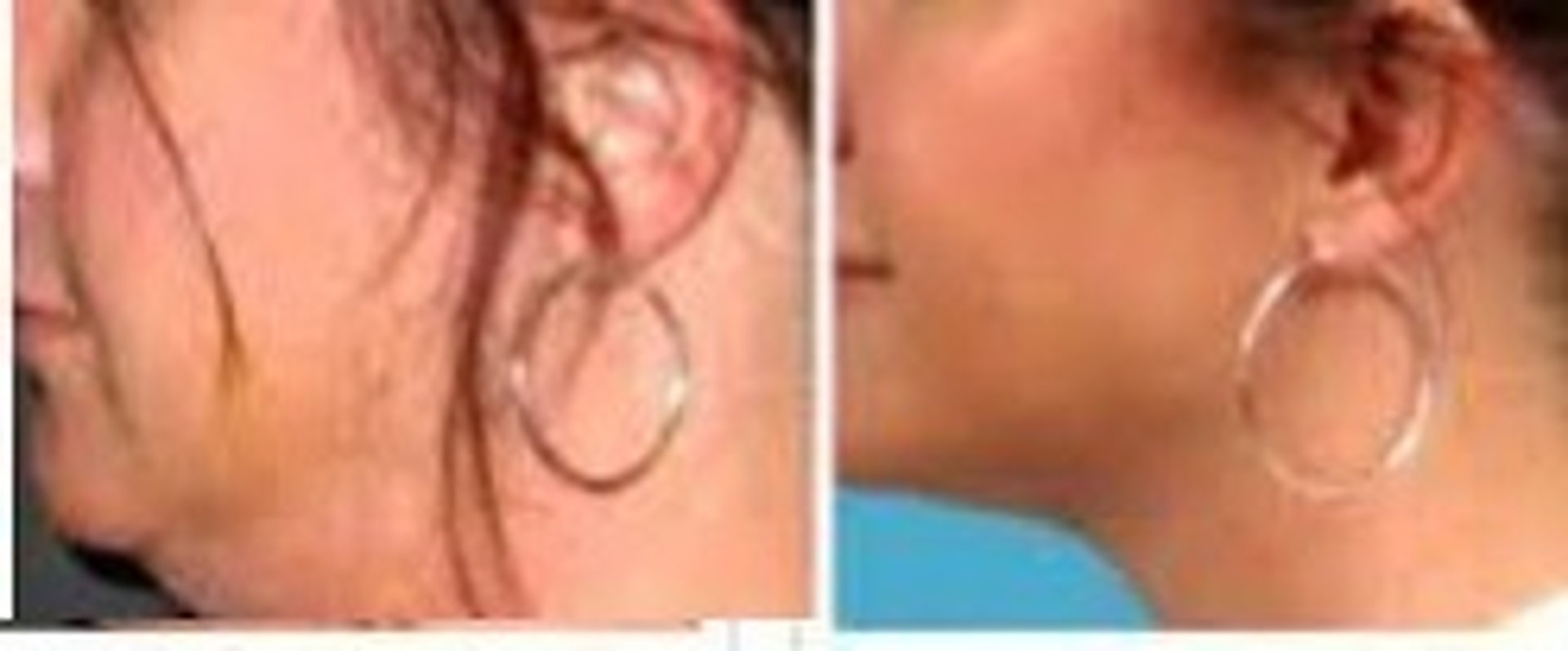 before and after fat mezo