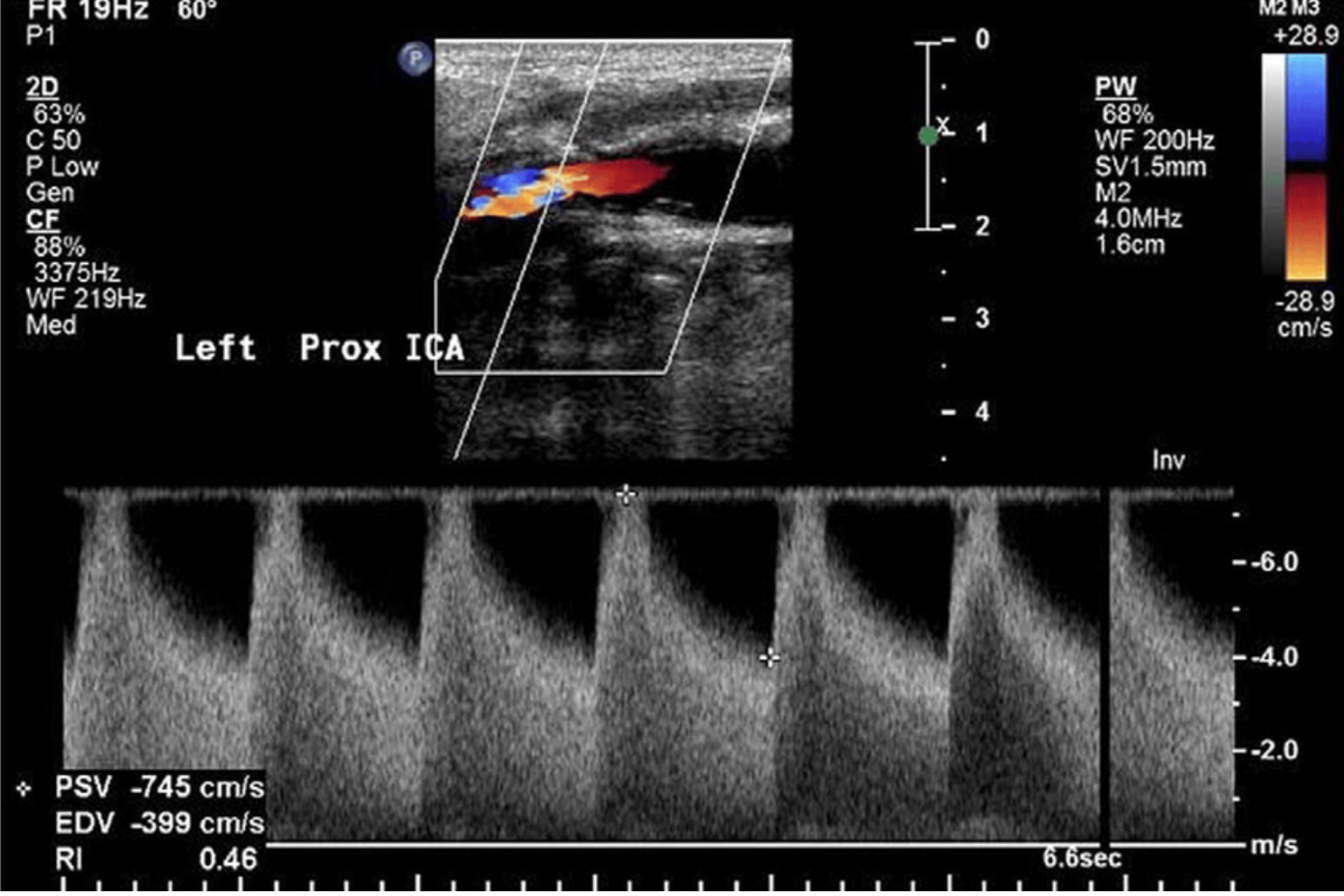 High-res image duplex ultrasound of severe carotid stenosis.