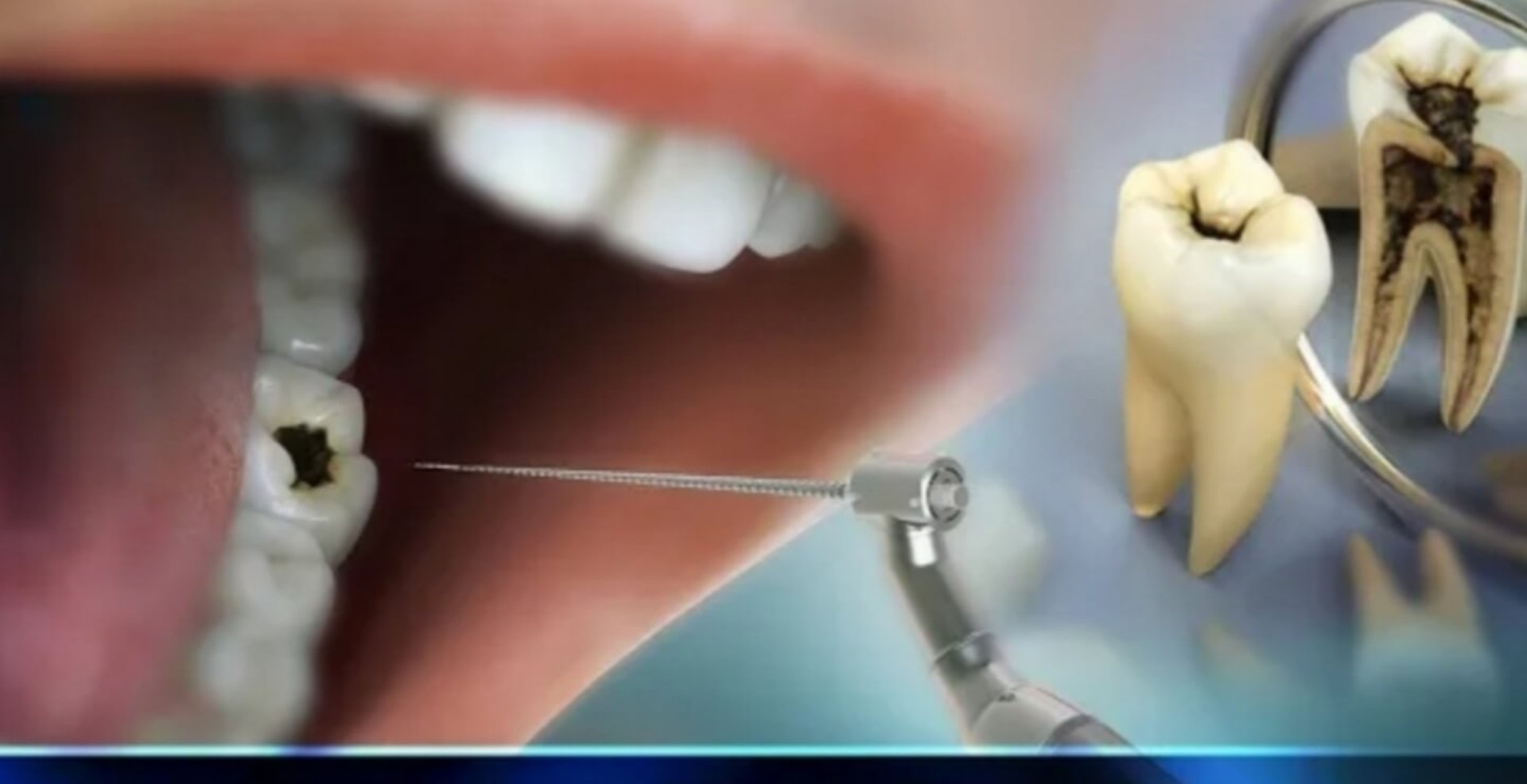 Root canal treatment procedure at Peoples Dental Clinic in Greater Noida