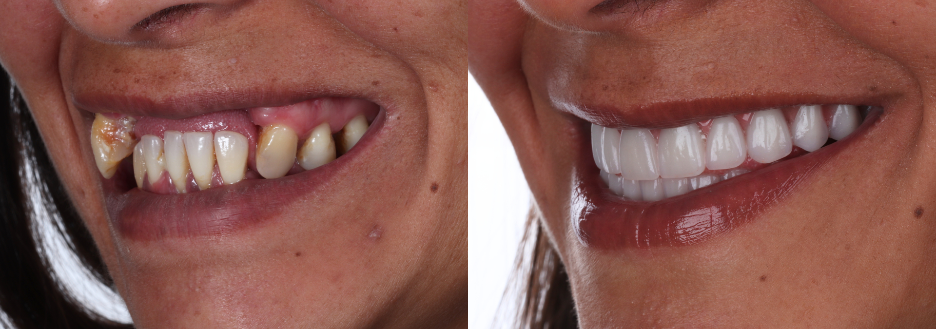 CASO #1 - PRÓTESE FIXA