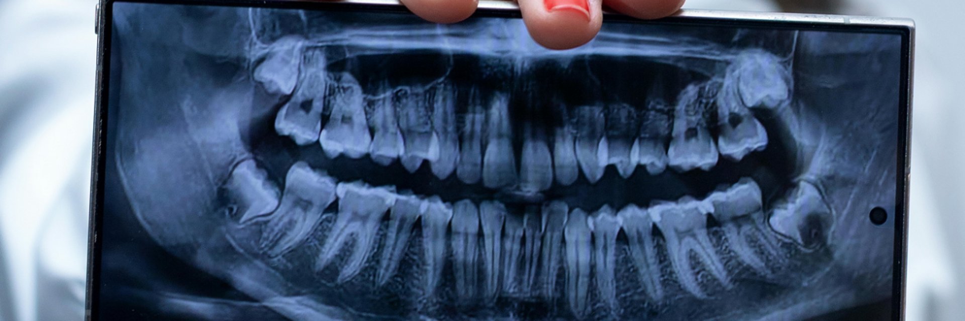 Dentista em São MAteus do Sul  realizando tratamento de canal em paciente
