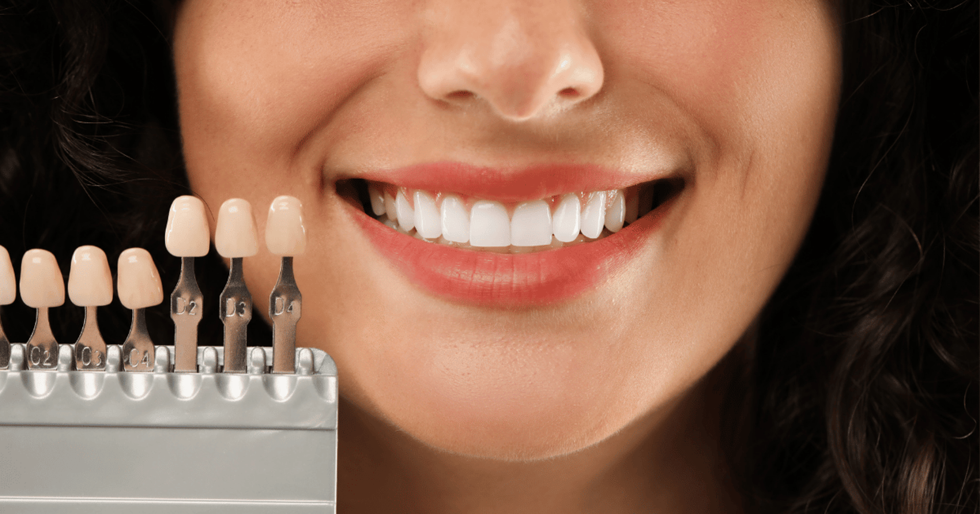 Paciente sorrindo após aplicação de facetas dentárias em porcelana