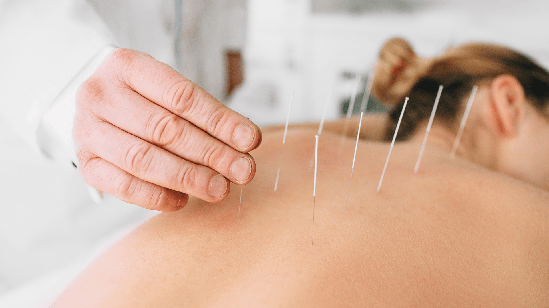acupuncturist putting needles on woman's back