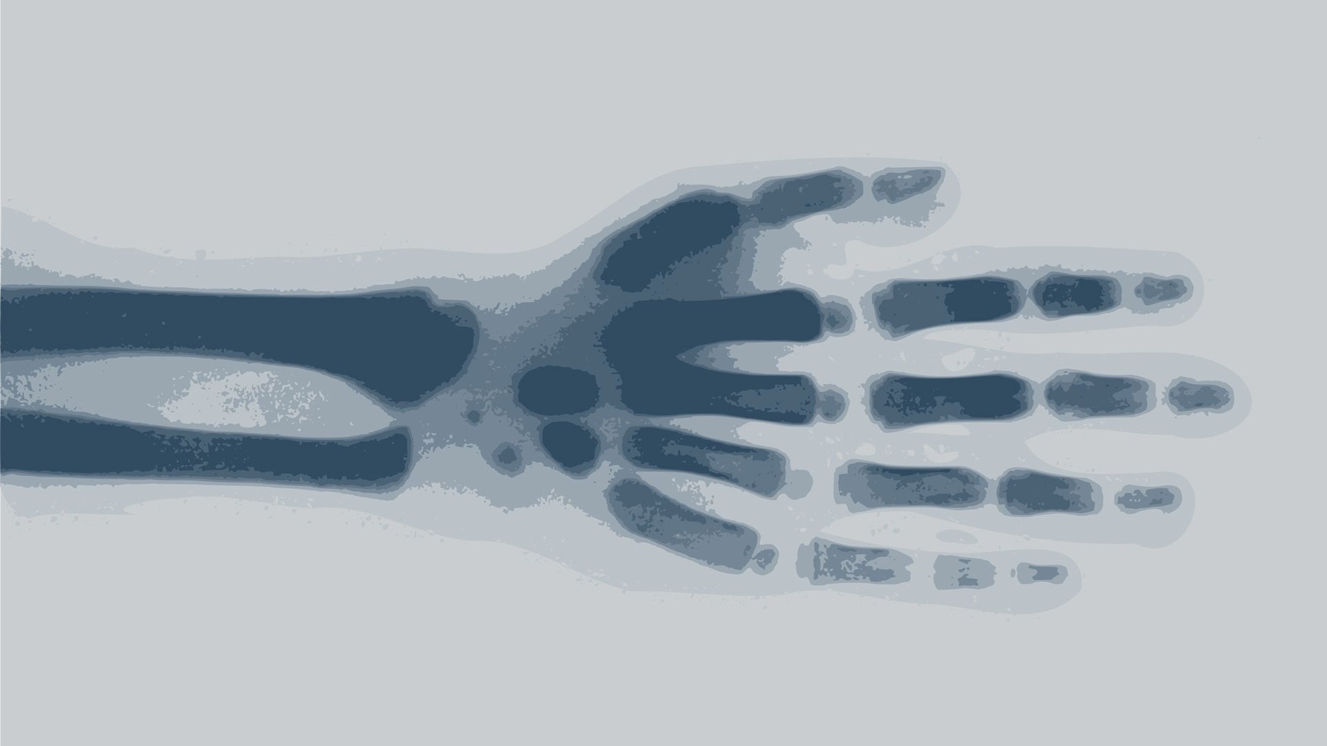 X-ray of a person's wrist and hand