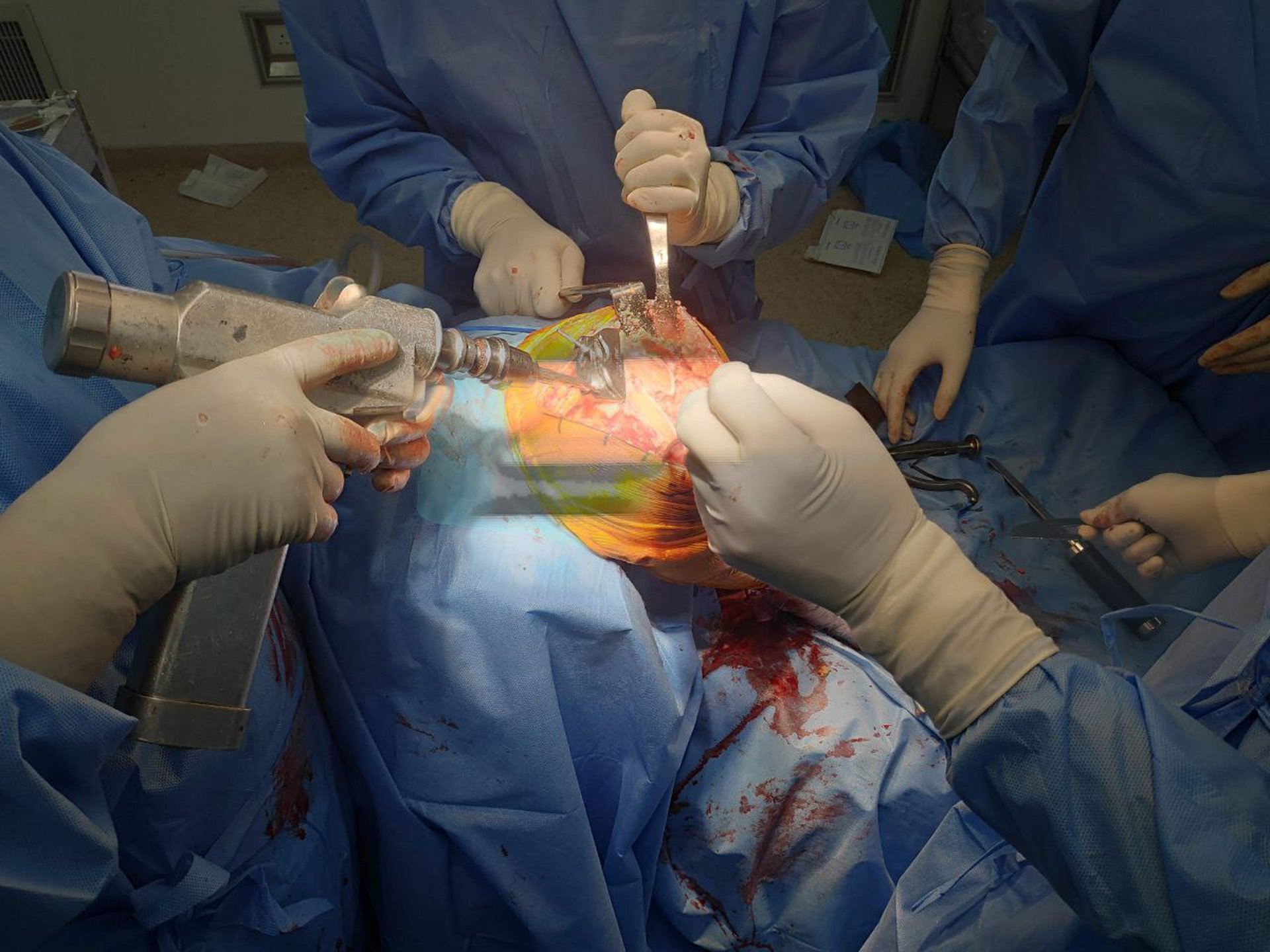 Total knee replacement surgery in Odisha with expert care