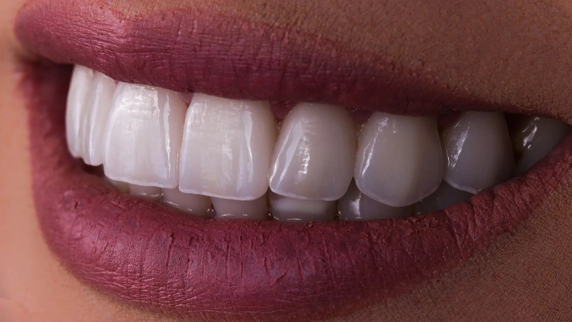 Pessoa sorrindo com dentes brancos e alinhados após tratamento com lentes de contato dental em Taguatinga.