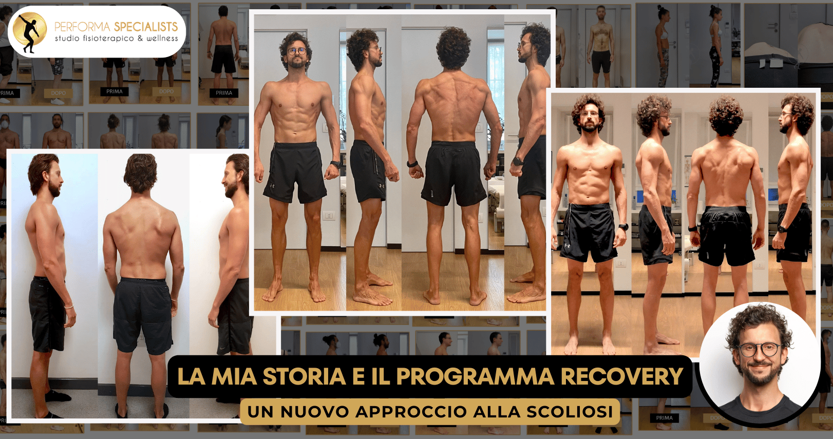 trattamento della scoliosi