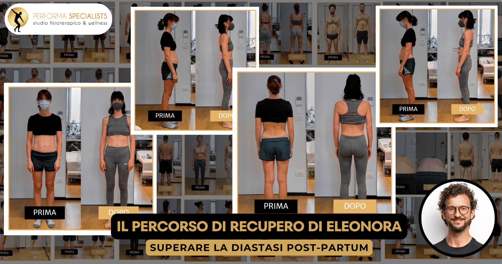 Curare la diastasi addominale by Performa Specialists Dott. Alessandro Rossin