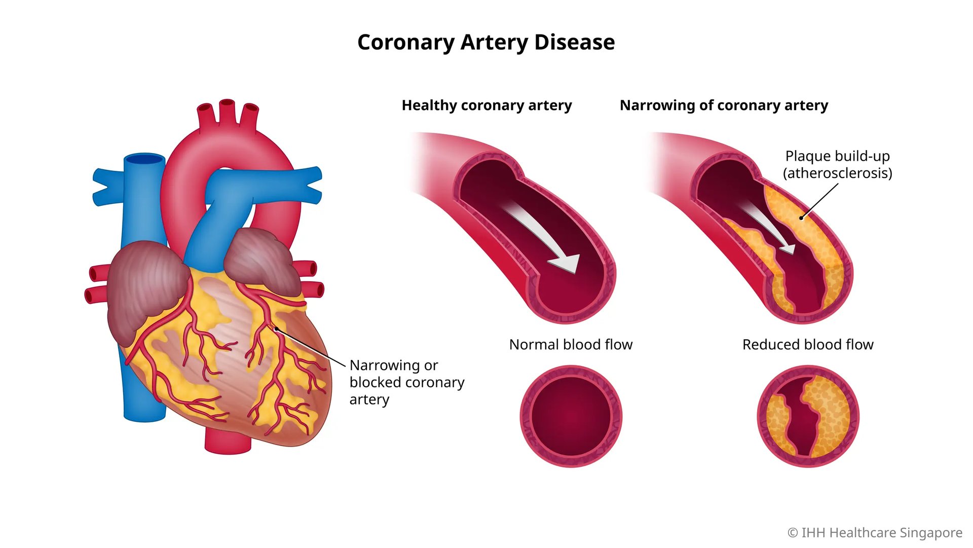 coronary artery disease