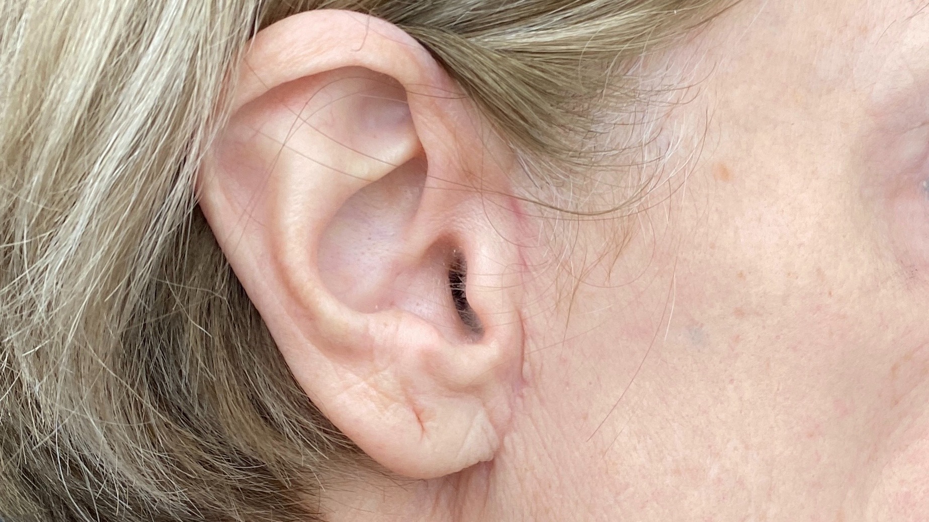 Mini facelift 75 yaş hasta görseli. Operasyondan birkaç ay sonrası. 