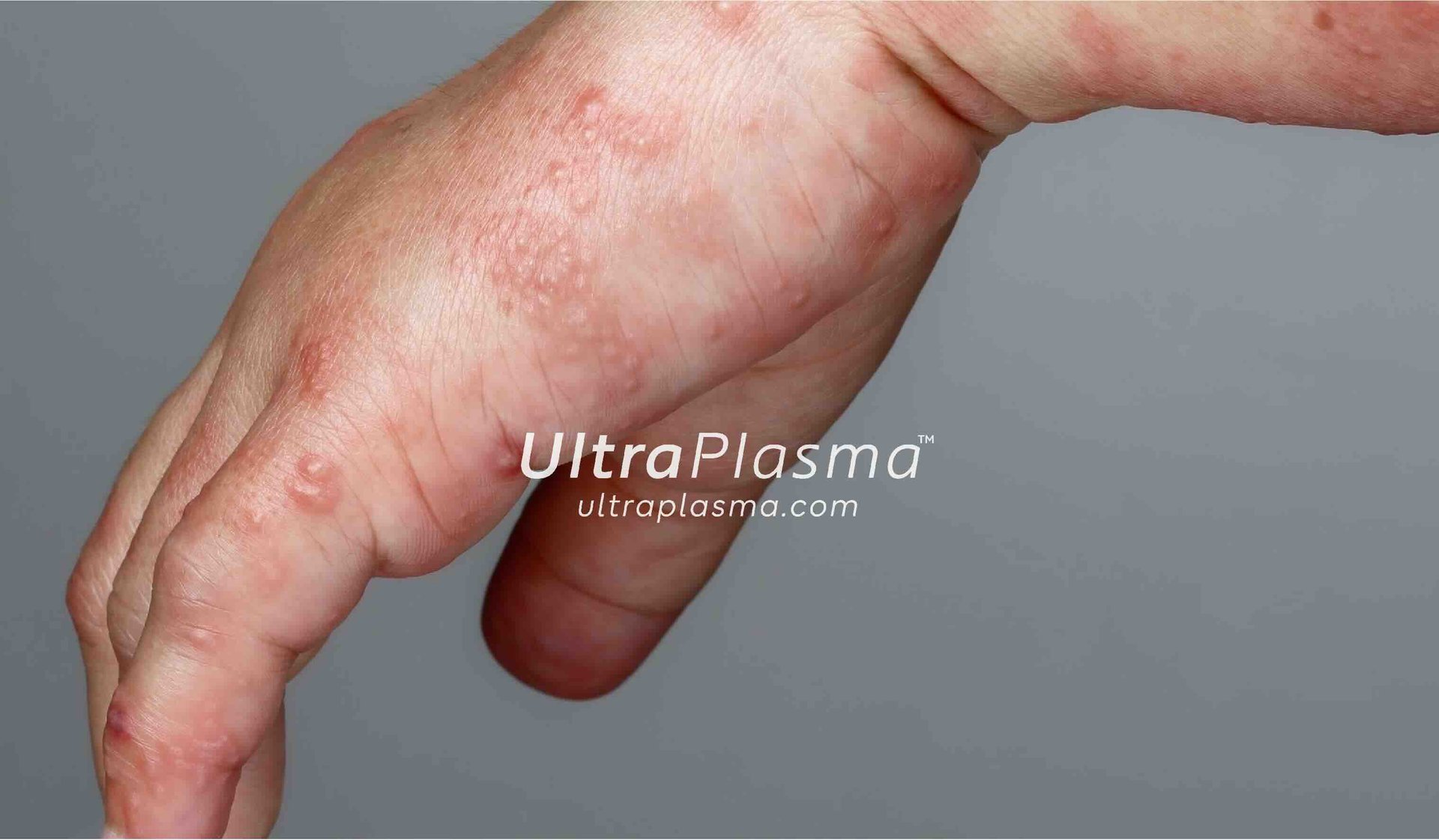 akne_acne_ultra_plasma_ultra_plazma_ultra-plasma_ultra-plazma