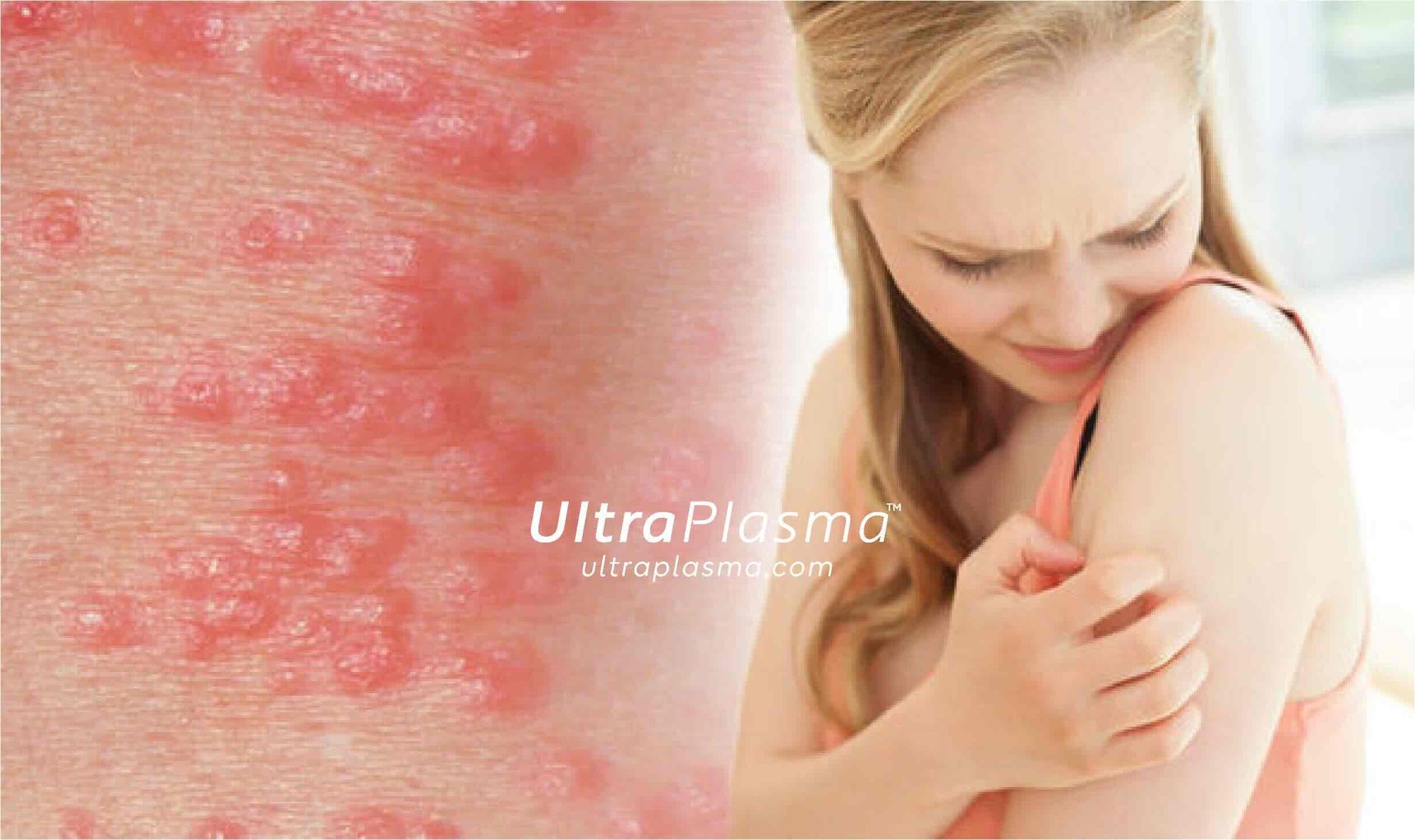 ultraplasma.com_Sarcoptes_scabiei_Infestation_Treatment_ultra_plasma_ultra_plazma