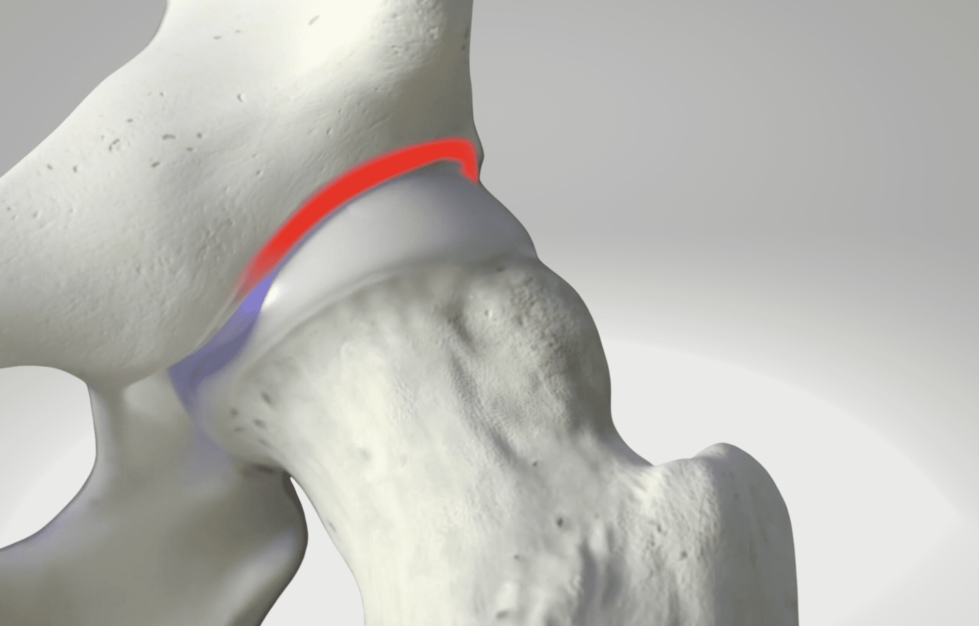Artroscopia do quadril