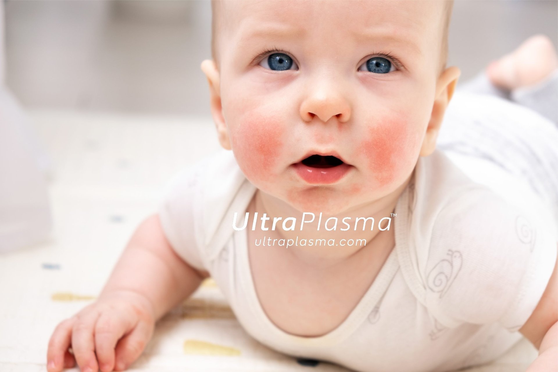 atopic_dermatitis_atopic_dermatit_egzama_eczemaultra_plasma_ultra_plazma_ultra-plasma_ultra-plazma