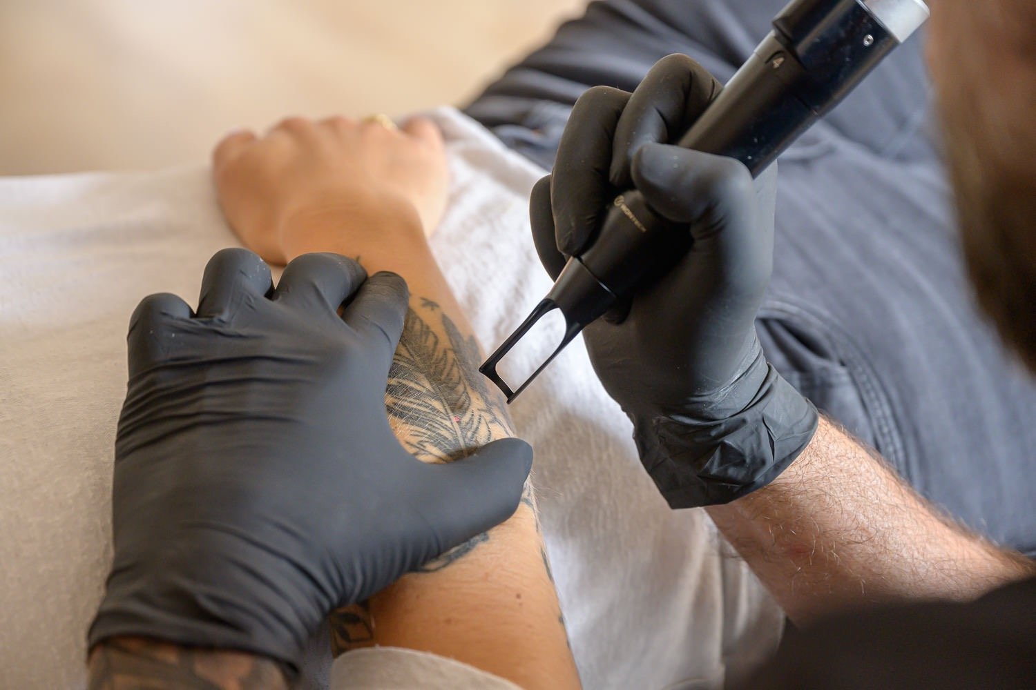 Tattoolaser Unterarm vorne