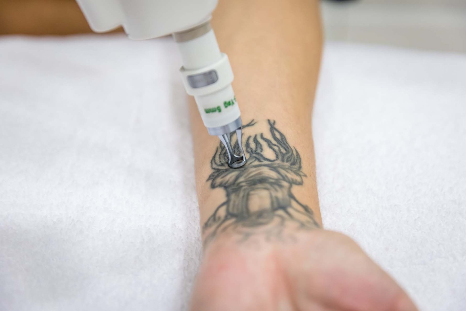 remocion laser de tatuajes