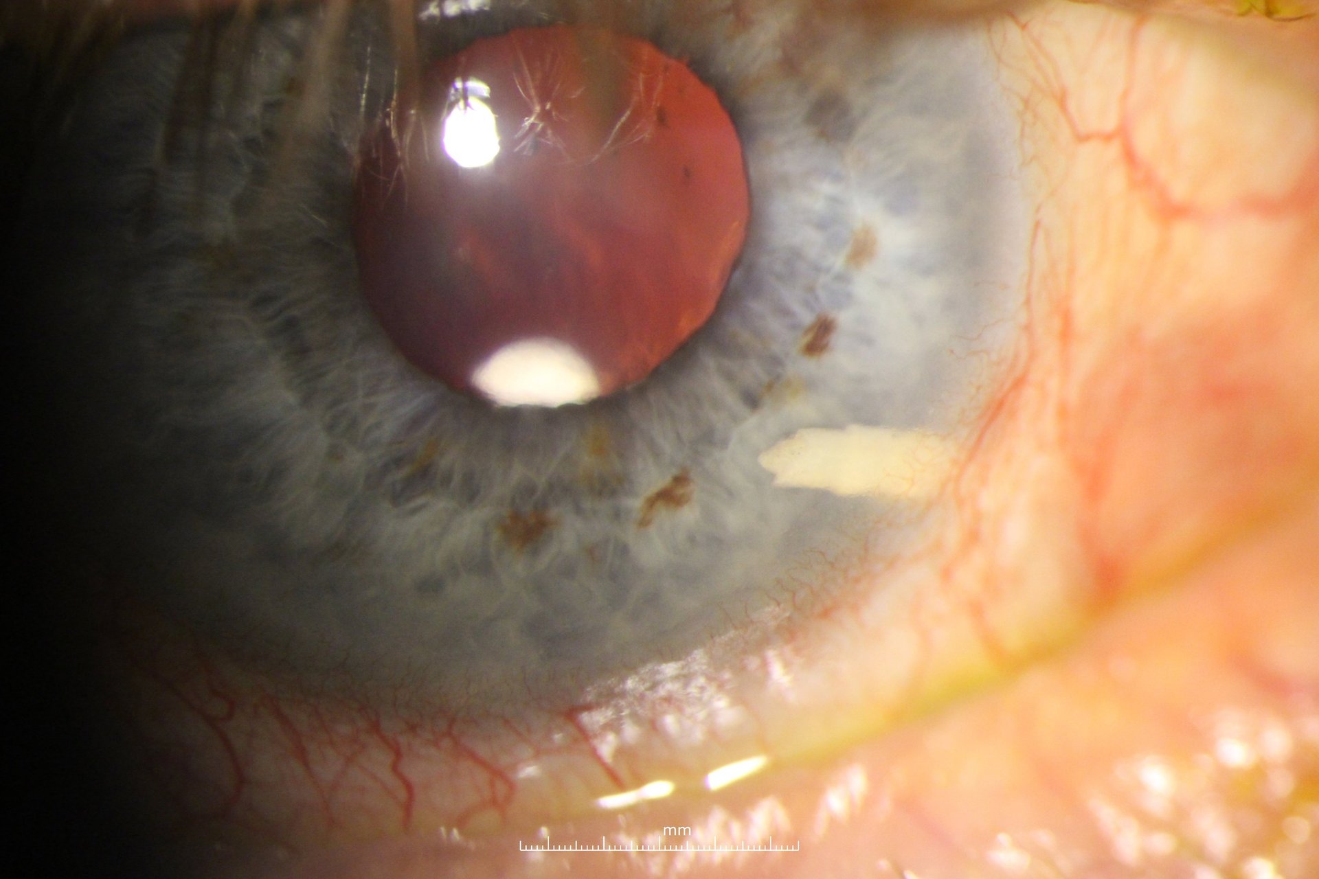 Alloflo scleral implant