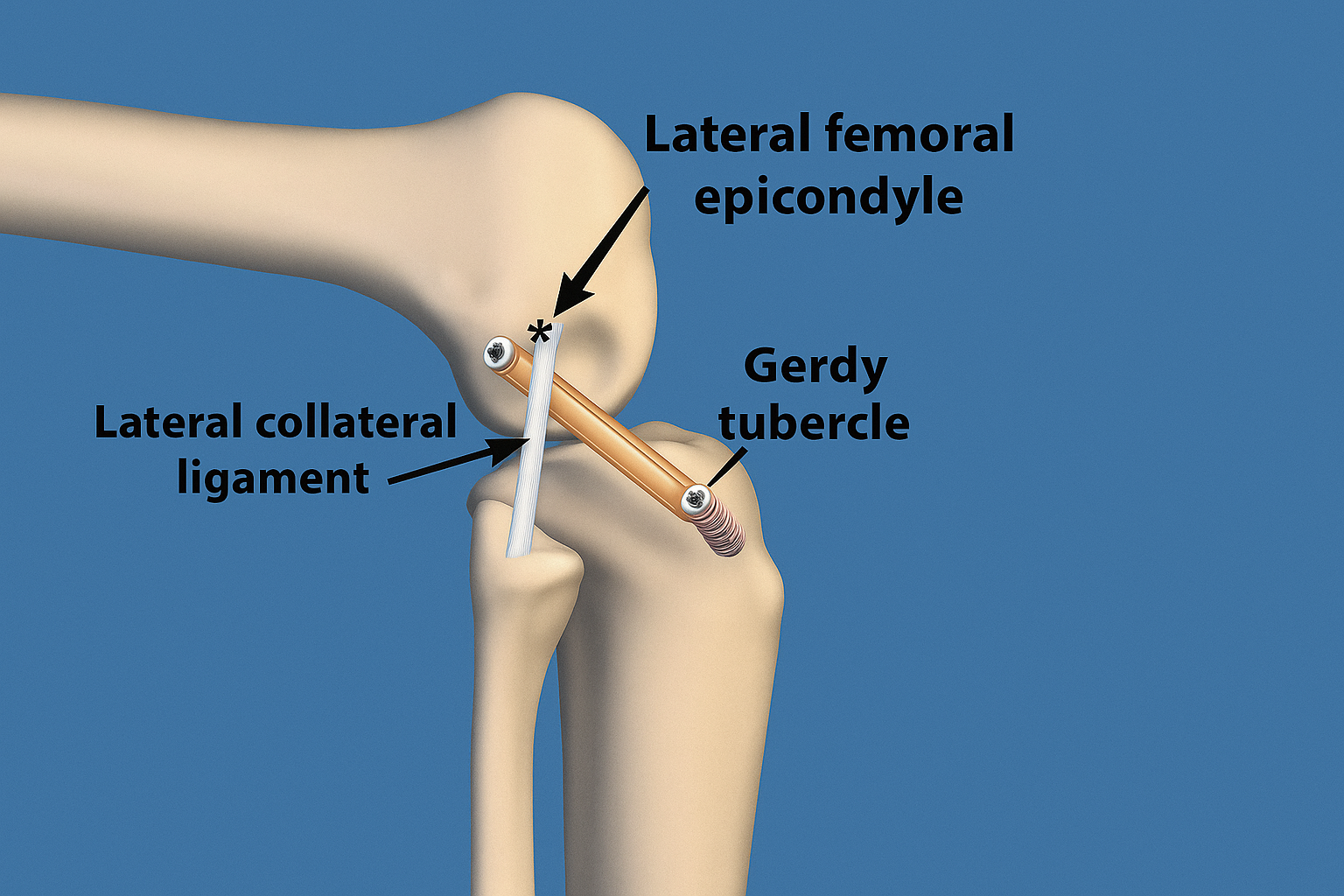 Lateral Extra-Articular Tendoesis (lET)
