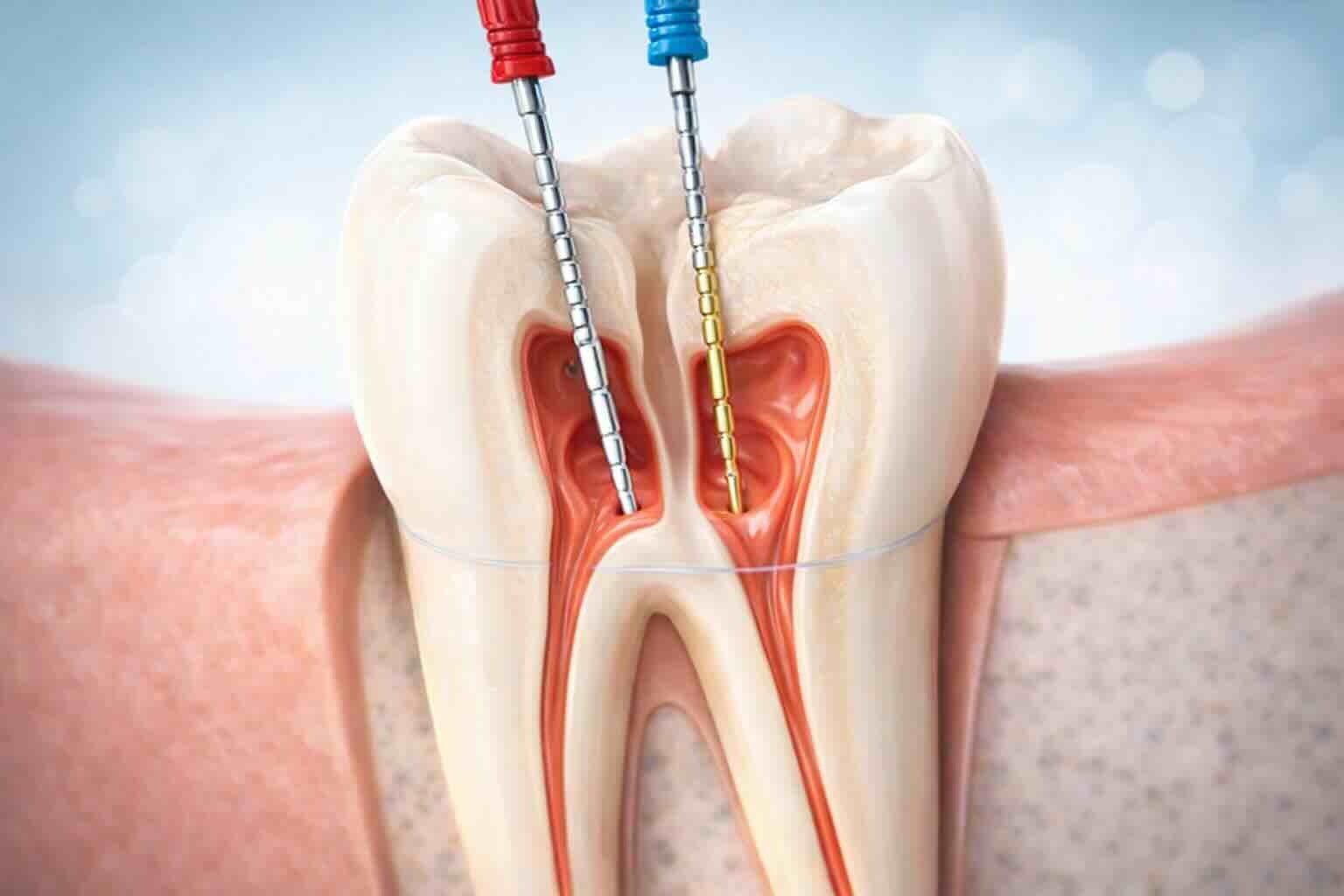root canal treatment