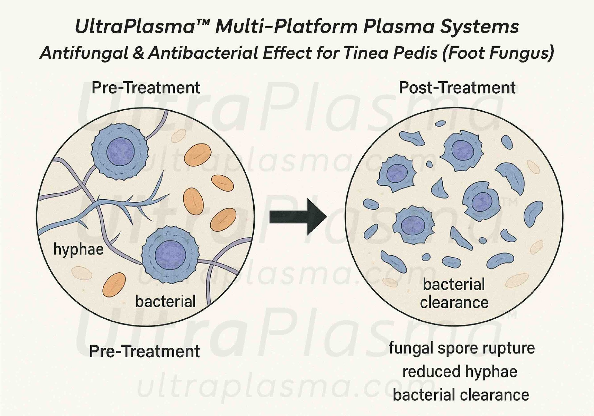 ultra_plasma_ultra_plazma_ultra-plasma_ultra-plazma_foot_fungus_ayak_mantari_tinea_pedis