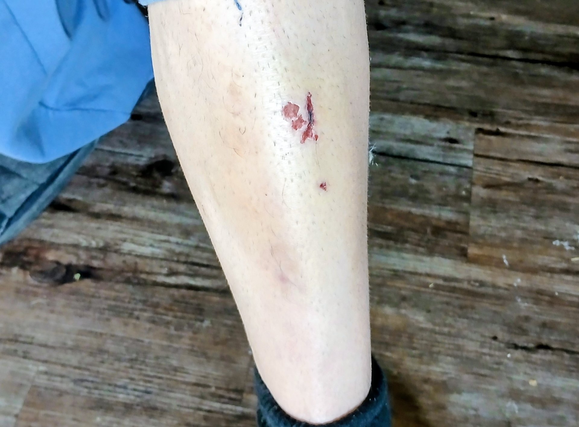 cut on shin fro pedal slip