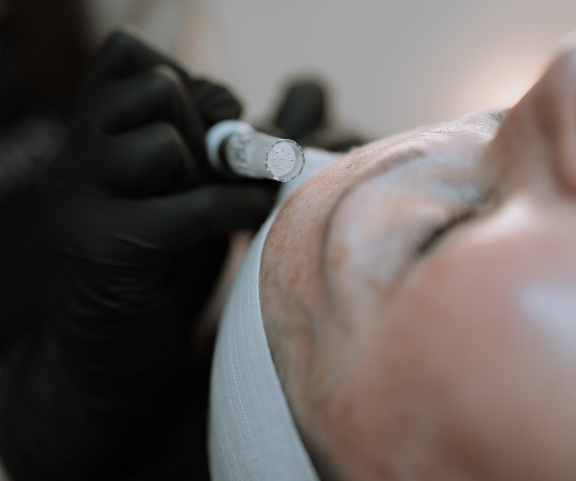 Microneedling treatment for acne scars and skin texture in Ashford Kent.