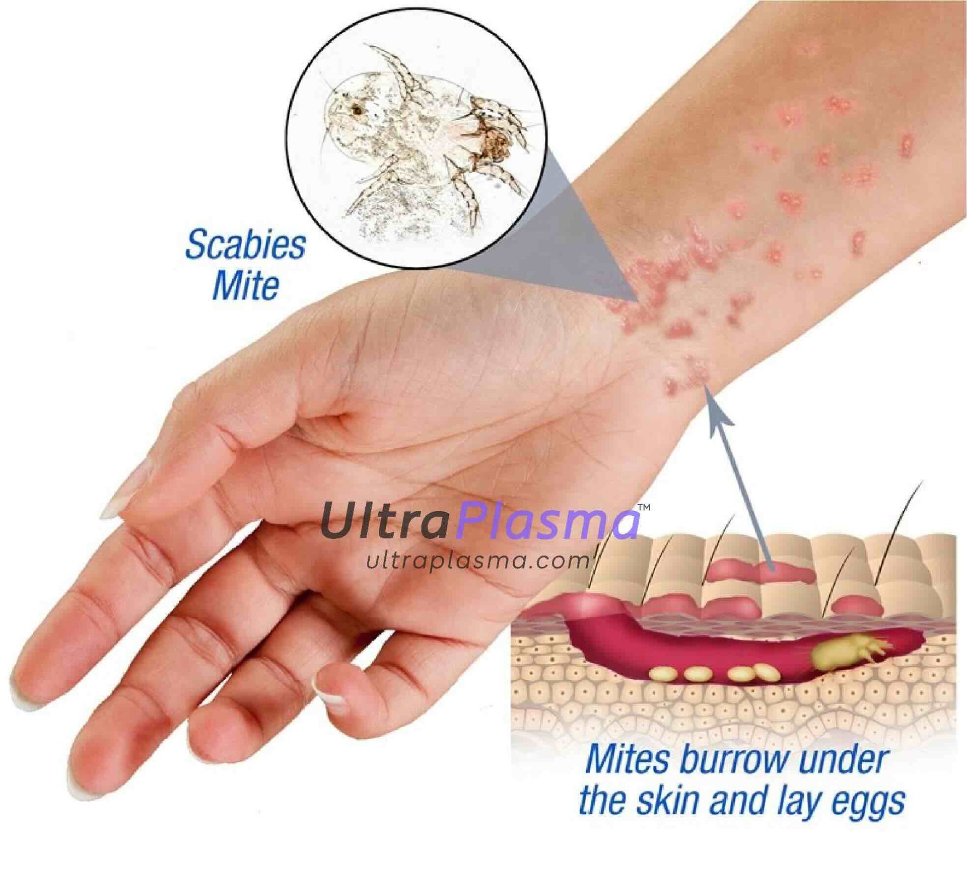 ultraplasma.com_Sarcoptes_scabiei_Infestation_Treatment_ultra_plasma_ultra_plazma