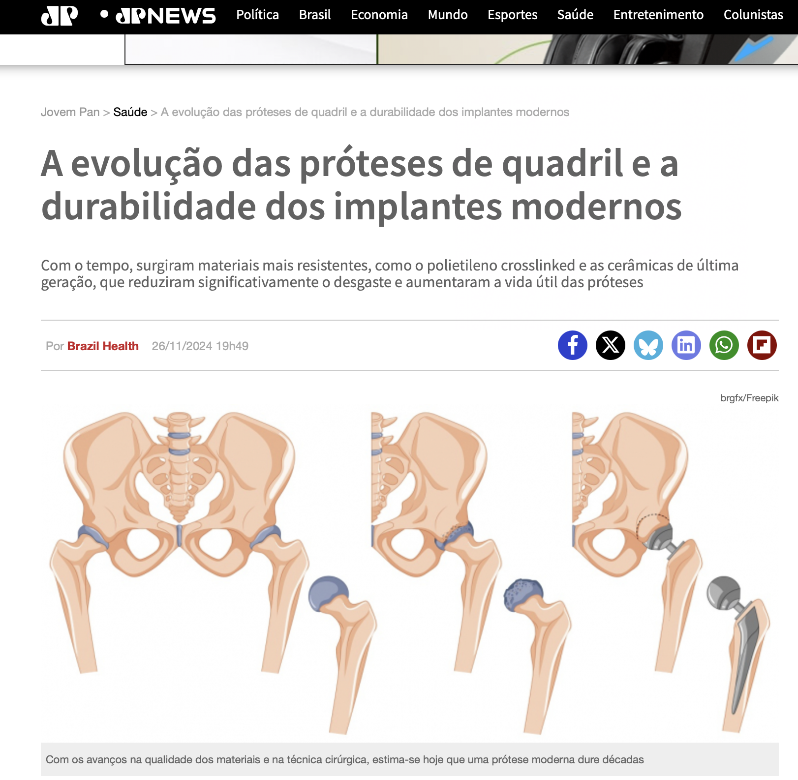 quanto tempo dura uma protese do quadril