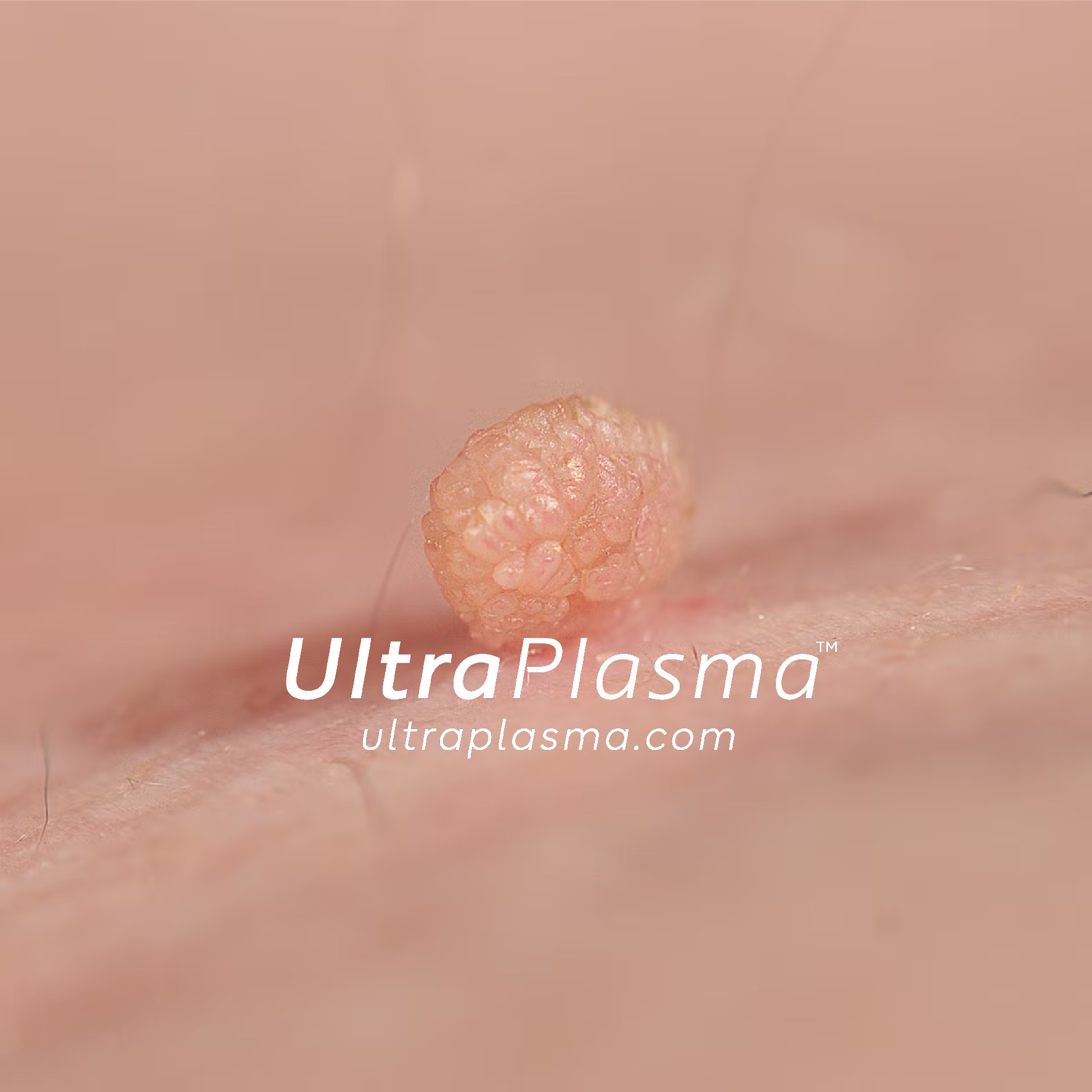 ultraplasma.com_skin_tag_removal_treatment_et_beni_temizleme_silme_tedavi_ultra_plasma_ultra_plazma2