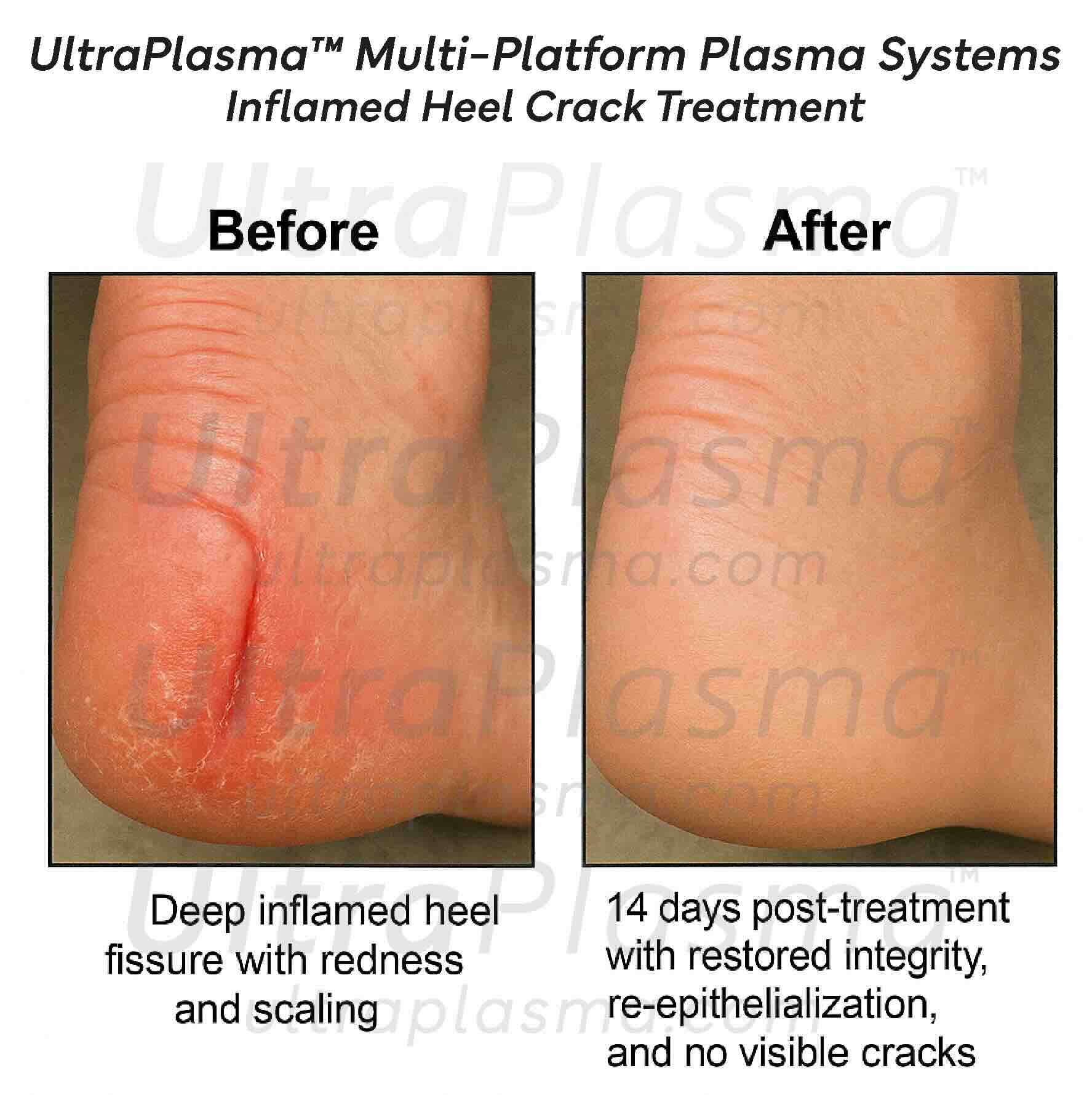 ultra_plasma_ultra_plazma_ultra-plasma_ultra-plazma