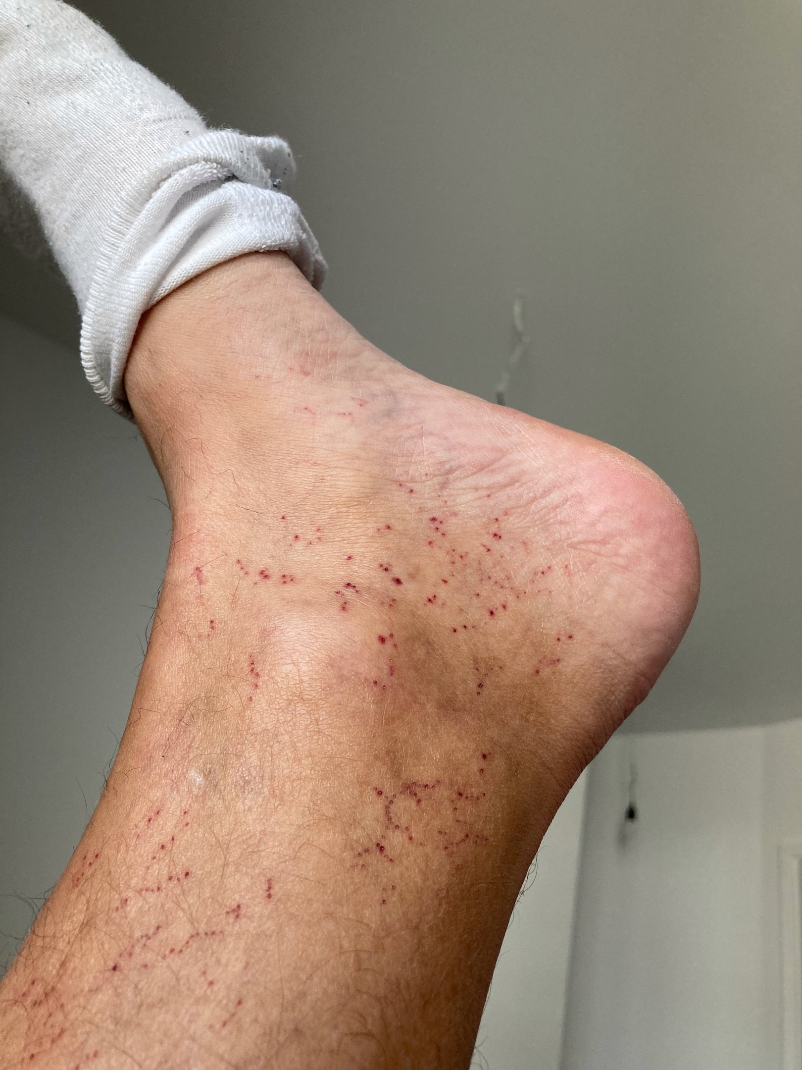little hematomas on the foot