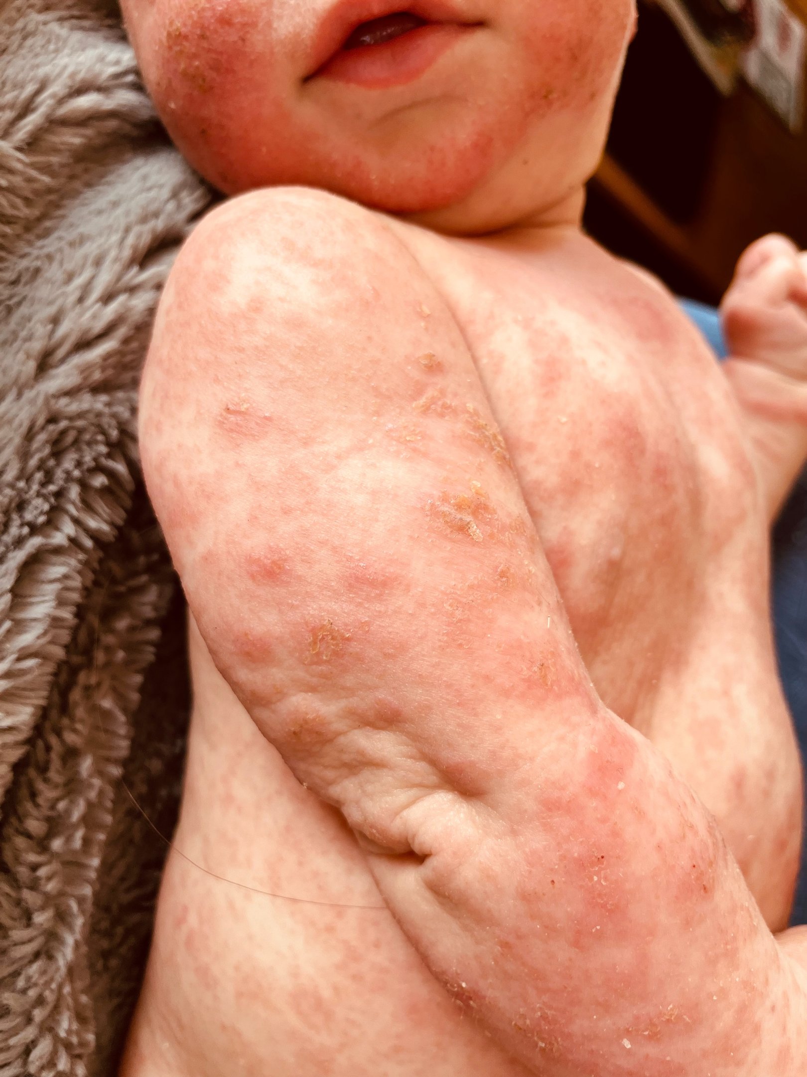 Eczéma présent sur tout le corps d'un bébé avec de grandes plaques