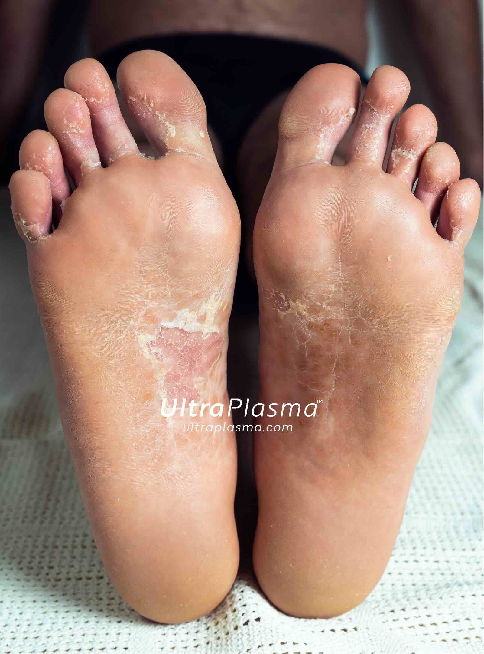 ultra_plasma_ultra_plazma_ultra-plasma_ultra-plazma_foot_fungus_ayak_mantari_tinea_pedis