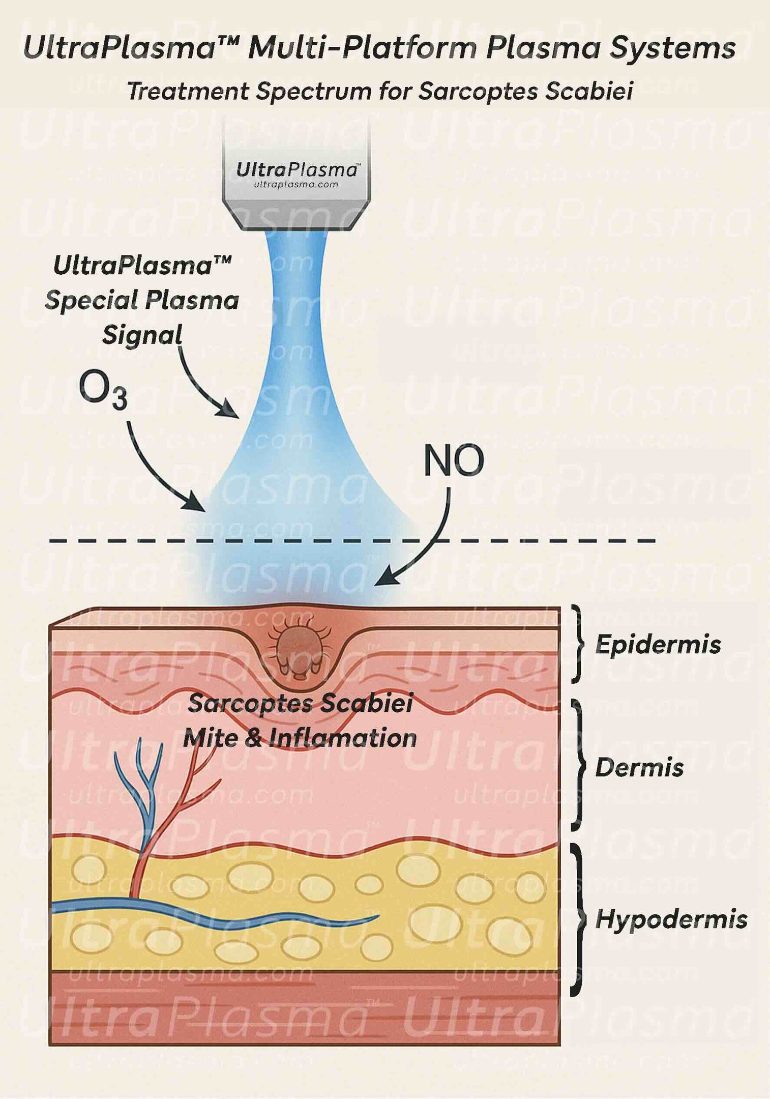 ultraplasma.com_Sarcoptes_scabiei_Infestation_Treatment_ultra_plasma_ultra_plazma