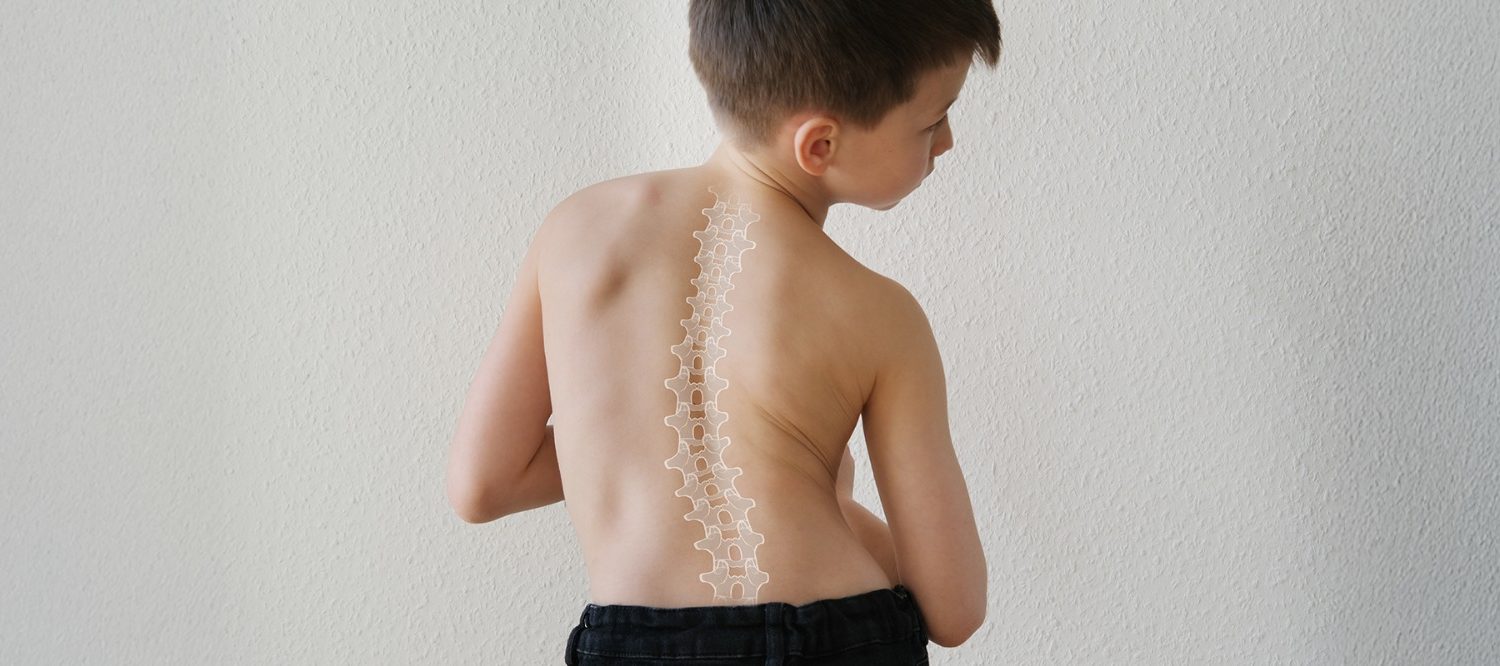 Scoliosis & Spinal Deformities at Bone Care One Day Surgery Center