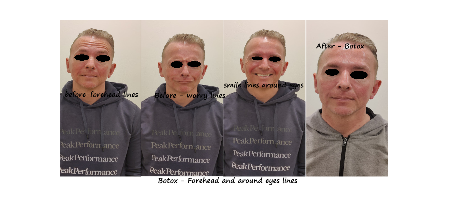 Before and after image of botox in forehead, glabella and around eyes: reduced wrinkles..